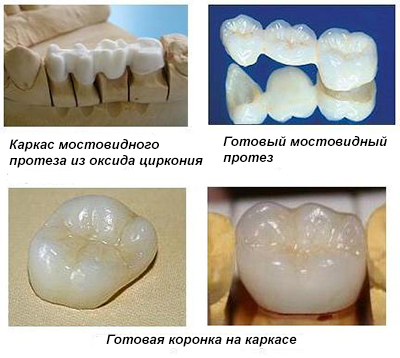 протезирование